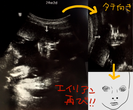 妊婦生活レポ 2 24週 正面エコー ちびお日記